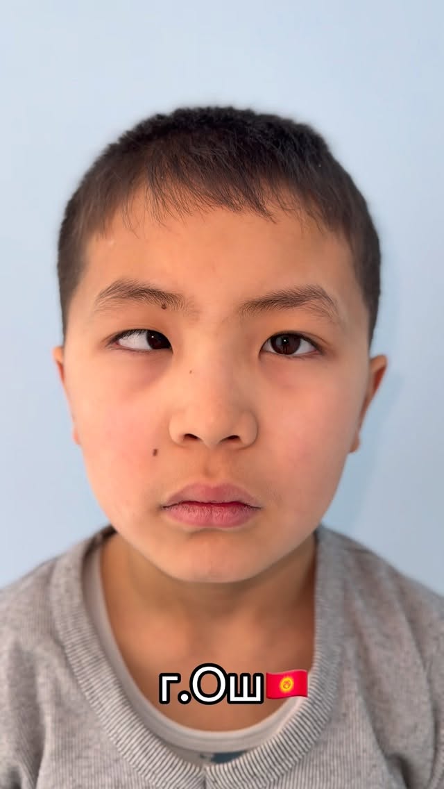 Исправление косоглазия